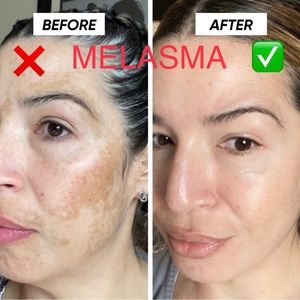 Tonico Despigmentante 🇨🇴 *Eliminador de manchas* Removes dark spots + ac…